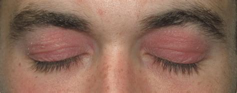 Eyelid Eczema