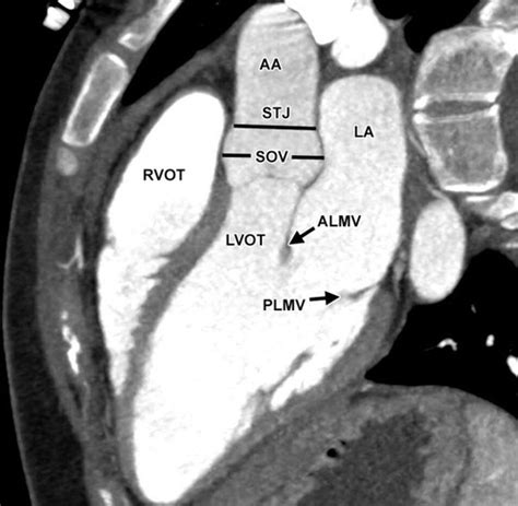Ct And Mr Imaging Of The Aortic Valve Radiologic Pathologic