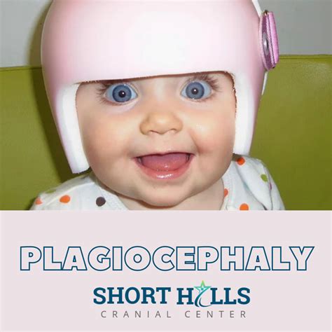 Heres How You Can Treat Plagiocephaly By Shorthillscranialcenter