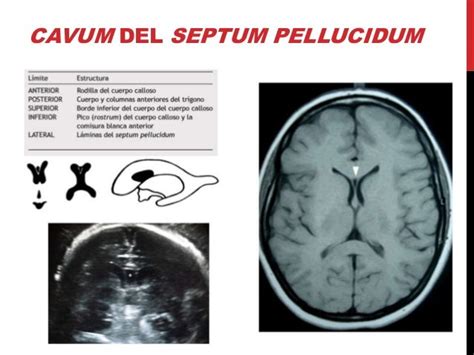 Variantes Anatómicas Del Septum Pellucidum