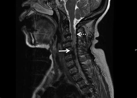 Mri Sagittal And Axial Images Of Cervico Dorsal Spine