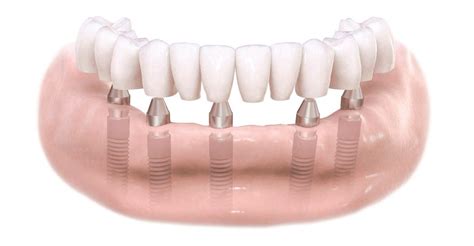 Implantes De Carga Inmediata Implantes Dentales Toledo Dentista Toledo