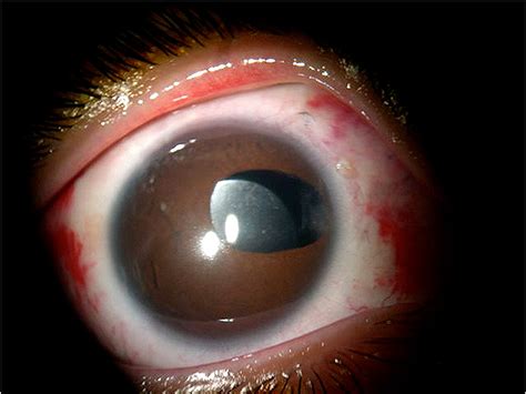 Dislocation Of Intraocular Lens Download Scientific Diagram