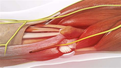 Cubital Tunnel Release Double Board Certified Orthopedic Surgeons