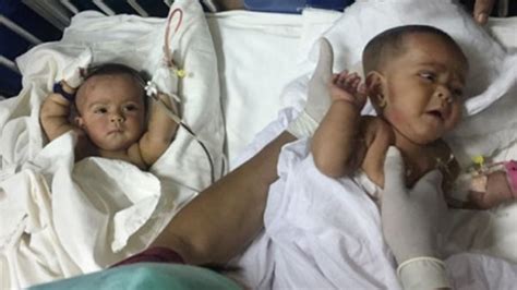 Bangladesh Separates Conjoined Twins In Rare Surgery Ctv News