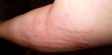 Hives Rash 10 Serious Conditions That Rashes And Hives Can Indicate