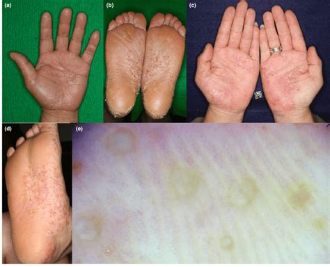 Typical Clinical Presentations Of Ab Palmoplantar Pustulosis Ppp