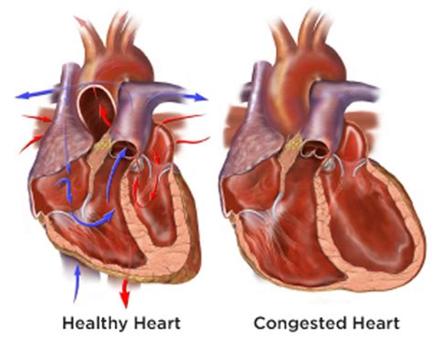 Congestive Heart Failure Chf Causes Symptoms