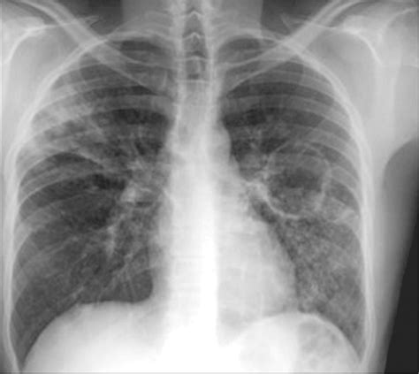 Pulmonary Infections Associated With Non Tuberculous Mycobacteria In