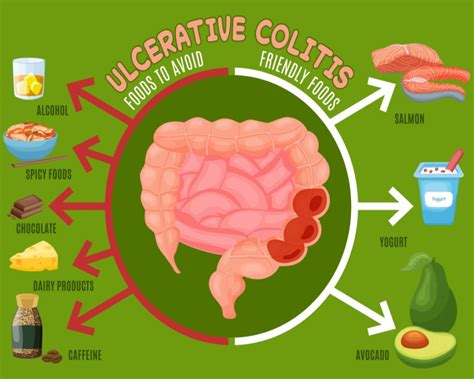What Is Ulcerative Colitis The Ibs And Gut Health Clinic