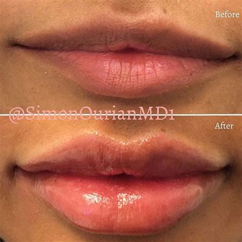 This Trusted Dermatologists Shares Her Insider Tips On What You Should Know Before Getting Lip