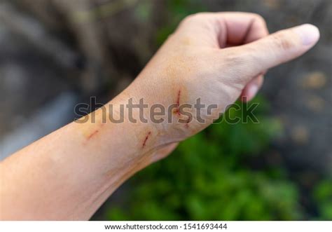 Hand Bloody Scars Cat Scratch Prevent Stock Photo 1541693444 Shutterstock
