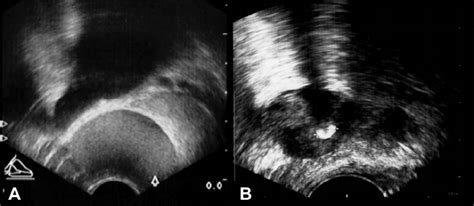 Transrectal Ultrasound Of The Prostate A Dilated Seminal Vesicle On