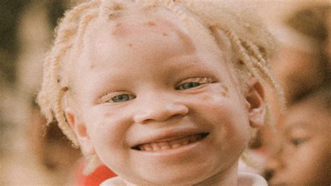 International Albinism Awareness Day What You Need To Know Oneindia News