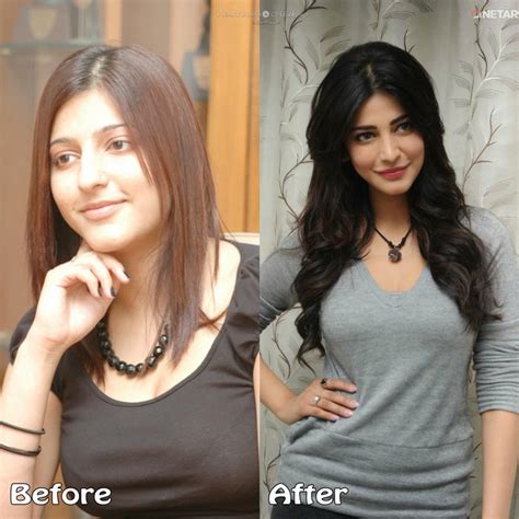 Top 10 Bollywood Plastic Surgeries Disasters Before