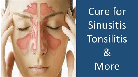 Cure Sinusitis Tonsilitis Congestion More Youtube