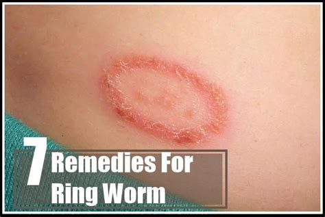 Remedies For Ring Worm Fungalrashtreatment Ringworm Ring Worm