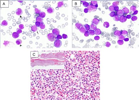 A Peripheral Blood Smear Shows Leukocytosis With Circulating Blasts