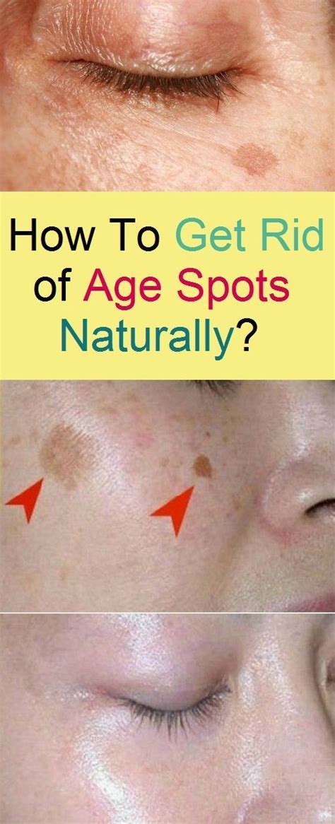 How To Get Rid Of Age Spots Naturally Brown Spots On Skin Spots On