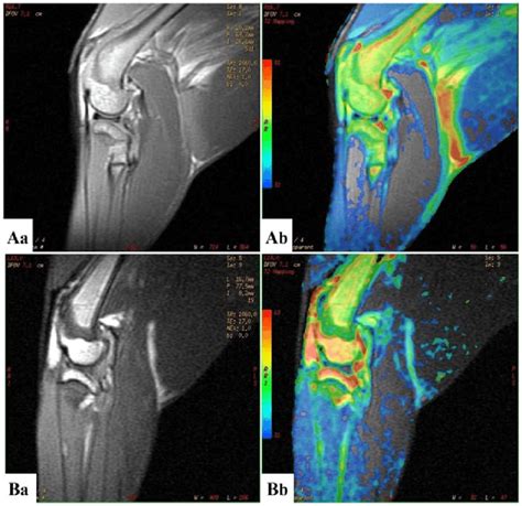 T2 Mapping In Saggital Position Of A The Normal Knee Joint And B