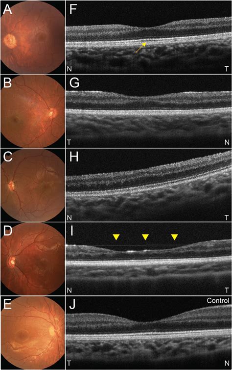 Representative Fundus Photographs Of Posterior Pole And Optical