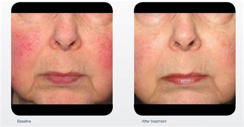 Cosmetic Lasers Long Beach Ipl Photorejuvenation Heller Dermatology