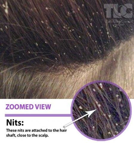 Nature created nits to be very resistant so they can survive in the toughest conditions. This is head lice at it's worse. All those nits (eggs ...