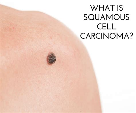 What Is Squamous Cell Carcinoma Oakland Hills Dermatology