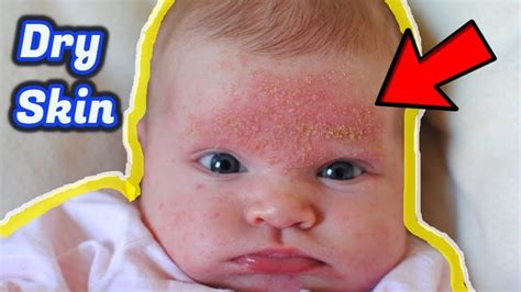 Baby Dry Skin Care Home Remedies For Dry Skin Baby Dry Skin Skin