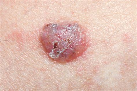Nodular Basal Cell Skin Cancer