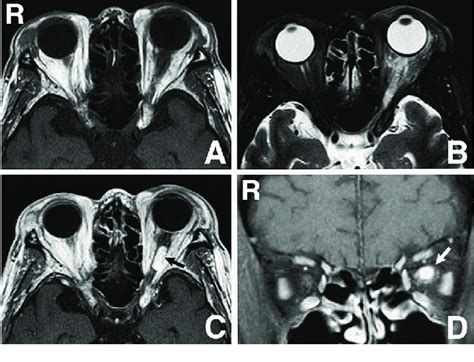 Magnetic Resonance Images Showing A Mass Arrows In The Swollen Left