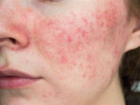 Rosacea How To Spot The Signs And Calm Your Skin