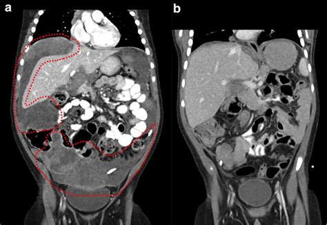 Imaging Of Diffuse Peritoneal Carcinomatosis A At Diagnosis Main