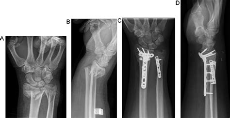 Safety Of Immediate Open Reduction And Internal Fixation Of Geriatric