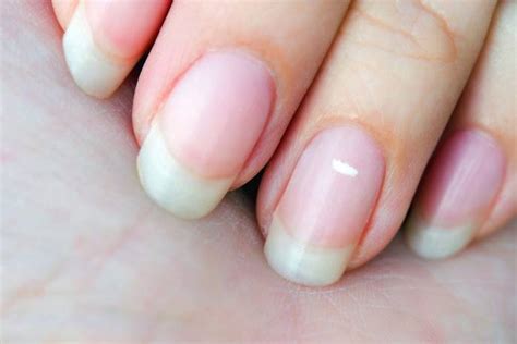 Reasons For White Lines On The Nails 2024