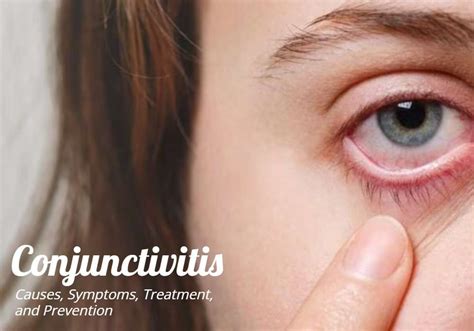 Conjunctivitis Pink Eye Causes Symptoms Treatment And Prevention