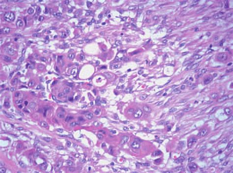 Poorly Differentiated Carcinoma Showing Pleomorphic Cells With Dense