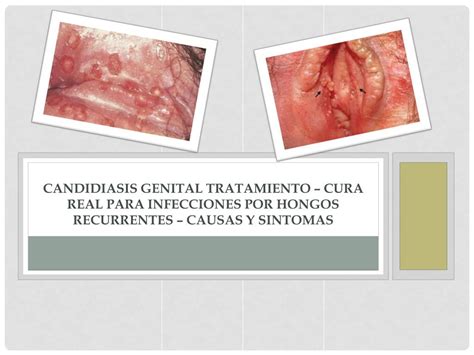 Ppt Candidiasis Genital Tratamiento Cura Real Para Infecciones Por