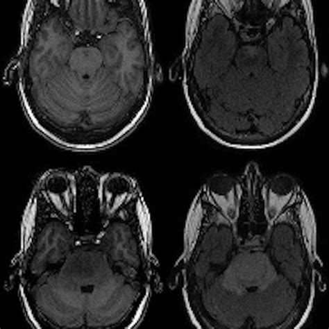 Brain Mri Surprises With Incidental Findings Auntminnie