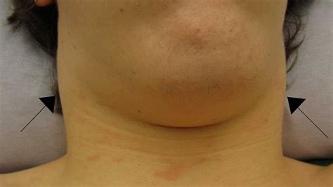 Swelling Of Lymph Nodes In Neck