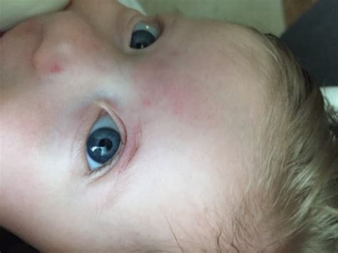 Little Red Dots On Sons Face July 2016 Babycenter Canada