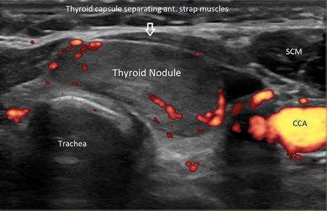 Radiofrequency Ablation Offers A Nonsurgical Treatment For Thyroid Nodules Newsroom Ut