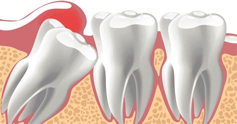 Zatrzymany ząb przyczyny objawy i leczenie
