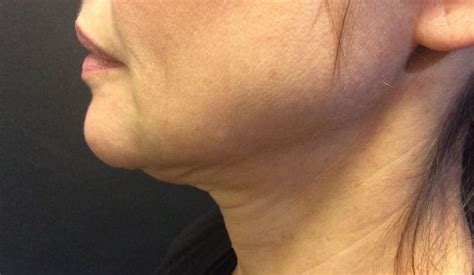 Advertorial Treating Cosmetic ‘tech Neck For Patients Post Lockdown