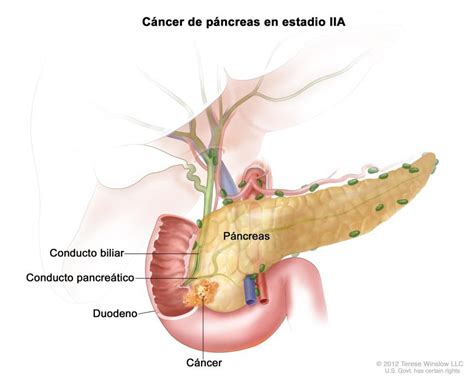 Symptoms include jaundice and abdominal pain, but these might not appear until the later. Tumor de Páncreas - Cirujano Monterrey