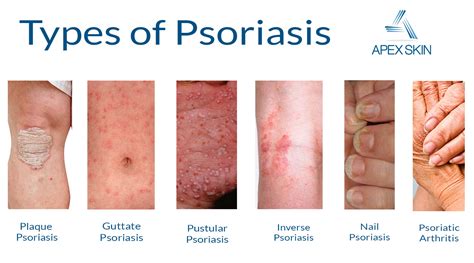 Psoriasis Psoriasis Symptoms Types And Management