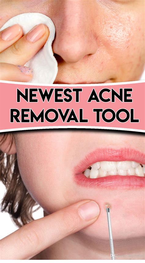 Pin On Removing Pimples