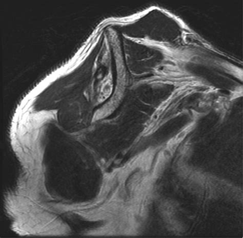 Suprascapular Neuropathy In Massive Rotator Cuff Tears With Severe