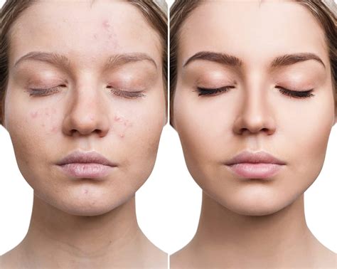 Acne Skin Cancer And Cosmetic Surgery Center Of Nj