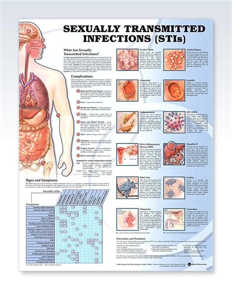 Sexually Transmitted Infections Chart 20x26 Medical Education